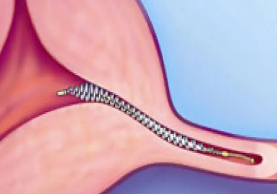 Essure