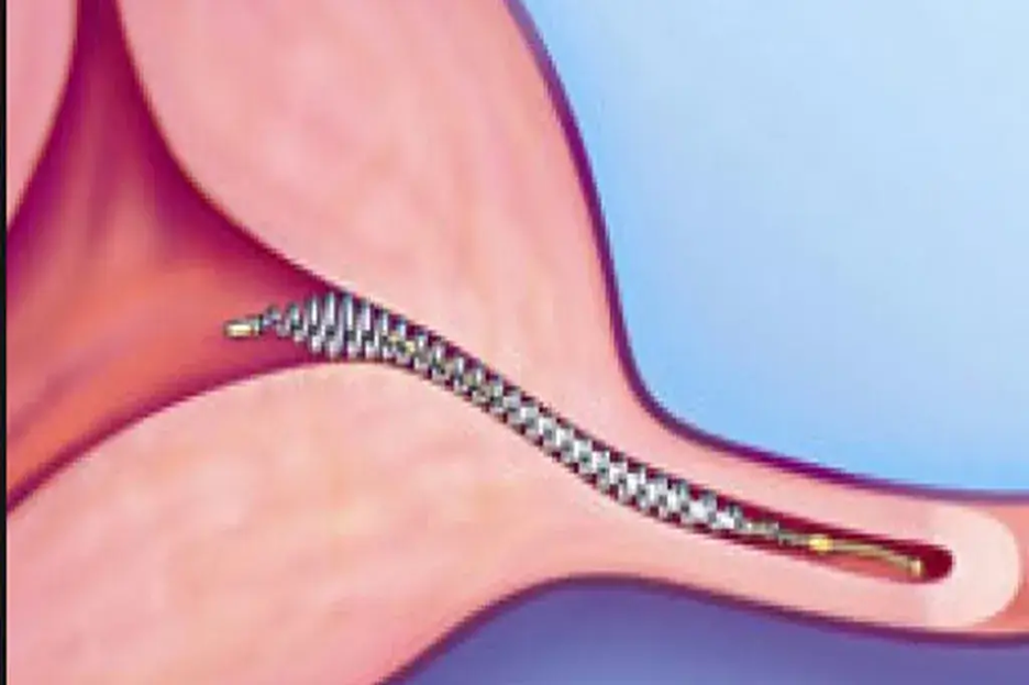 Essure